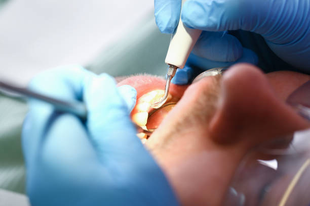 Best Broken or Cracked Tooth Emergency Dentist in Hilton, NY